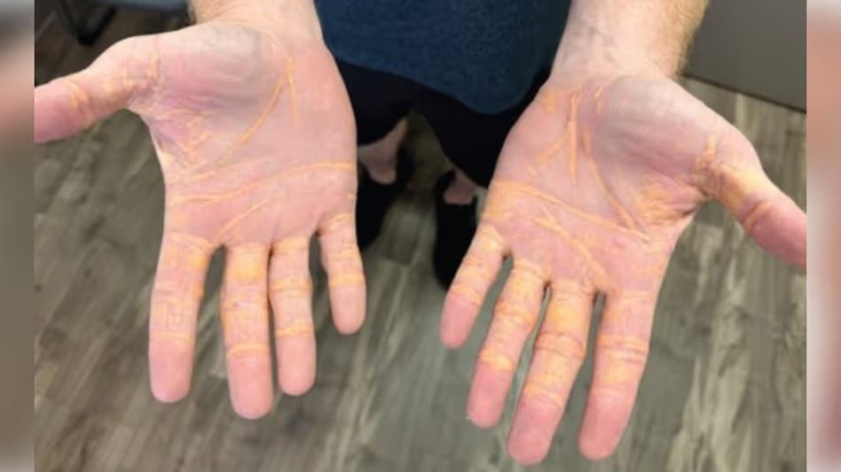 ശരീരത്തിൽ നിന്ന് കൊളസ്ട്രോൾ തനിയെ പുറന്തള്ളുന്ന അവസ്ഥ: മെഡിക്കൽ രംഗത്തെ ഞെട്ടിച്ച് യുഎസ് പൗരൻ