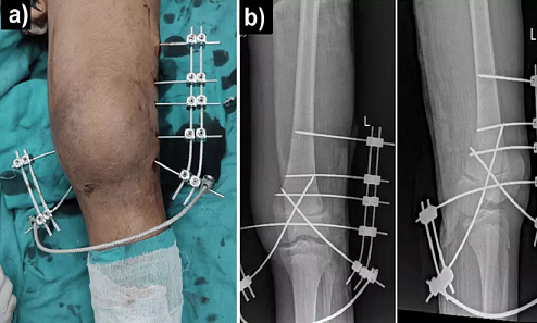 ഇന്ത്യയിൽ ശസ്ത്രക്രിയാ അണുബാധ നിരക്ക് ഉയർന്ന തോതിലെന്ന് ഐസിഎംആർ