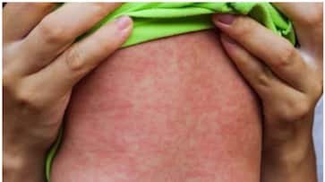 അമേരിക്കയിൽ ഒരു പതിറ്റാണ്ടിന് ശേഷം വീണ്ടും അഞ്ചാം പനി മരണം; വാക്സിനെടുക്കാത്ത കുട്ടി മരിച്ചെന്ന് സ്ഥിരീകരണം