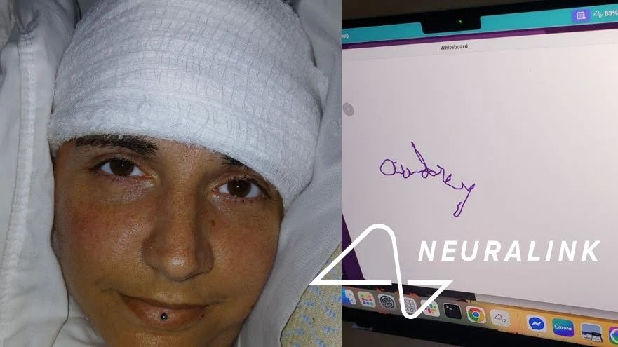 ശാസ്ത്രമുന്നേറ്റം! 20 വർഷമായി തളർന്നുകിടക്കുന്ന യുവതി ന്യൂറാലിങ്കിന്റെ സഹായത്താൽ സ്വന്തം പേരെഴുതി