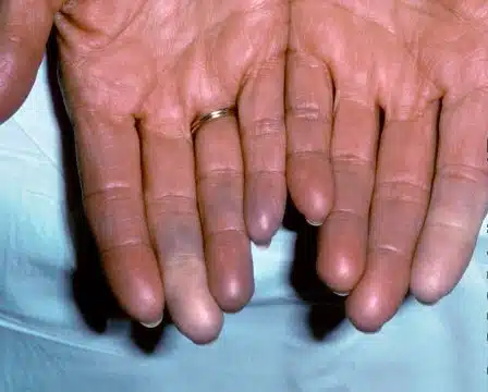 കൈകളിലും കാലുകളിലും നീലനിറം കാണുന്നുണ്ടോ? ശരീരം നൽകുന്ന ഈ മുന്നറിയിപ്പ് ശ്രദ്ധിക്കുക