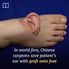 യുവതിയുടെ അറ്റുപോയ ചെവി കാലില്‍ തുന്നിച്ചേര്‍ത്ത് ഡോക്ടര്‍മാര്‍; അപൂര്‍വ ശസ്ത്രക്രിയയിലൂടെ വീണ്ടും തിരികെവച്ചു