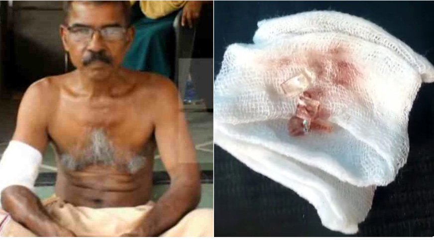 ചില്ല് നീക്കാതെ മുറിവ് തുന്നിക്കെട്ടി: ചേർത്തല താലൂക്ക് ആശുപത്രിക്കെതിരെ ആരോപണം