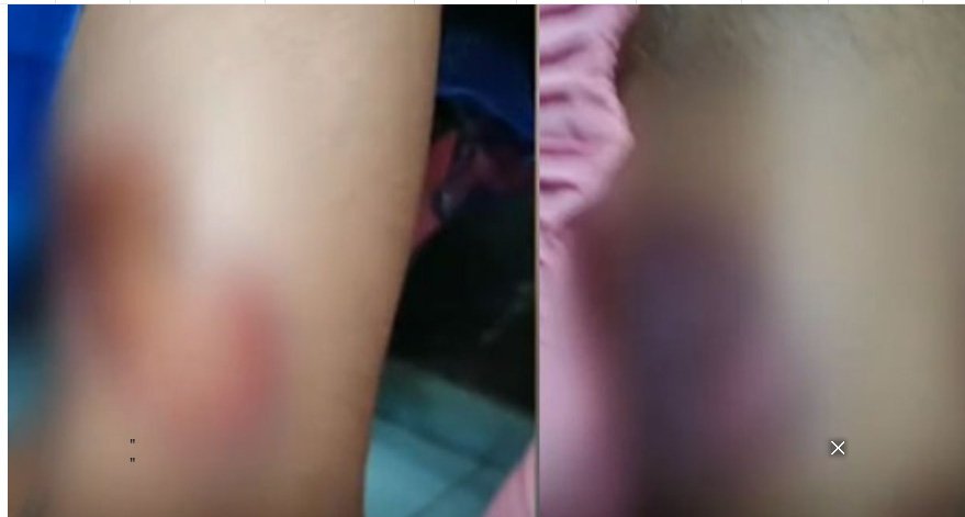 മ​ല​പ്പു​റ​ത്ത് ര​ണ്ടാ​ന​മ്മ​യു​ടെ ആ​ക്ര​മ​ണ​ത്തി​ൽ കു​ട്ടി​ക​ൾ​ക്ക് പ​രി​ക്ക്