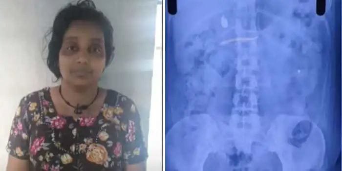 ക്ലിനിക്കിലെത്തിയ കുട്ടിയു‌ടെ 3.5 ഗ്രാം വരുന്ന സ്വര്‍ണമാല മോഷ്ടിച്ച ശേഷം വിഴുങ്ങി; യുവതിക്ക് എനിമ വച്ച്‌ കാത്തിരിപ്പ് മൂന്നാം ദിവസത്തിലേക്ക്