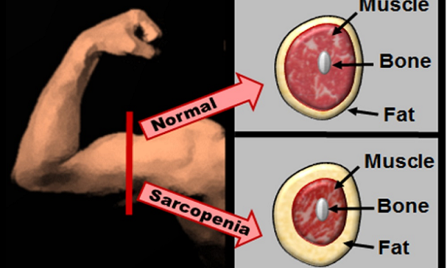 30 കഴിഞ്ഞവർ ജാഗ്രതൈ! നിങ്ങൾ അറിയാതെ സംഭവിക്കുന്ന സാർക്കോപീനിയ എന്ന വില്ലൻ