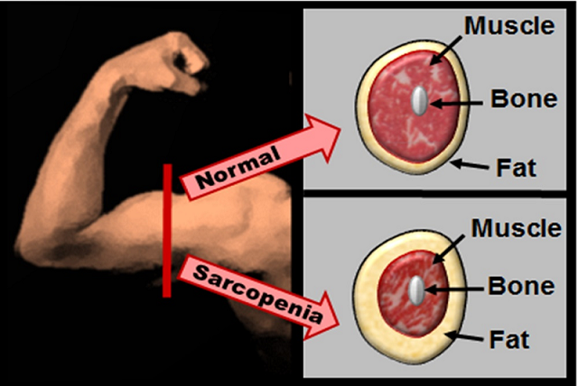 30 കഴിഞ്ഞവർ ജാഗ്രതൈ! നിങ്ങൾ അറിയാതെ സംഭവിക്കുന്ന സാർക്കോപീനിയ എന്ന വില്ലൻ
