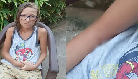 കോവളം ബീച്ചിൽ റഷ്യൻ ബാലന്‌ തെരുവ് നായയുടെ കടിയേറ്റു