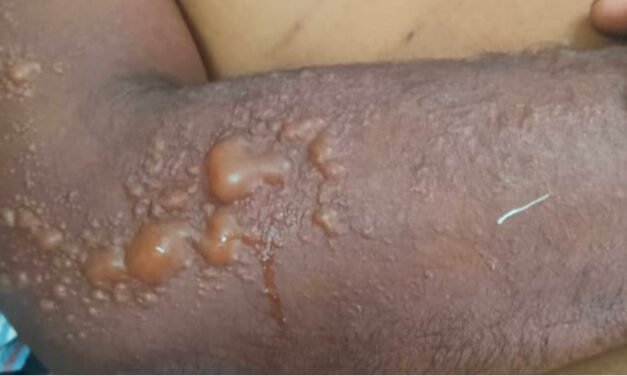 കൂത്താട്ടുകുളത്ത് അന്യസംസ്ഥാന തൊഴിലാളിക്ക് സൂര്യാഘാതമേറ്റു; ഗുരുതര പൊള്ളല്‍