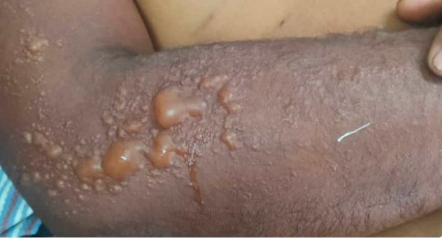 കൂത്താട്ടുകുളത്ത് അന്യസംസ്ഥാന തൊഴിലാളിക്ക് സൂര്യാഘാതമേറ്റു; ഗുരുതര പൊള്ളല്‍