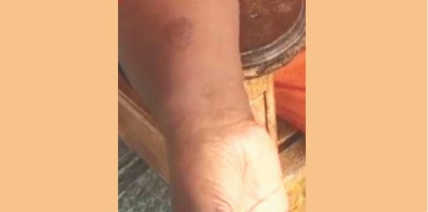 അ​ങ്ക​ണ​വാ​ടി അ​ധ്യാ​പി​ക​യ്ക്ക് സൂ​ര്യാ​ത​പ​മേ​റ്റു